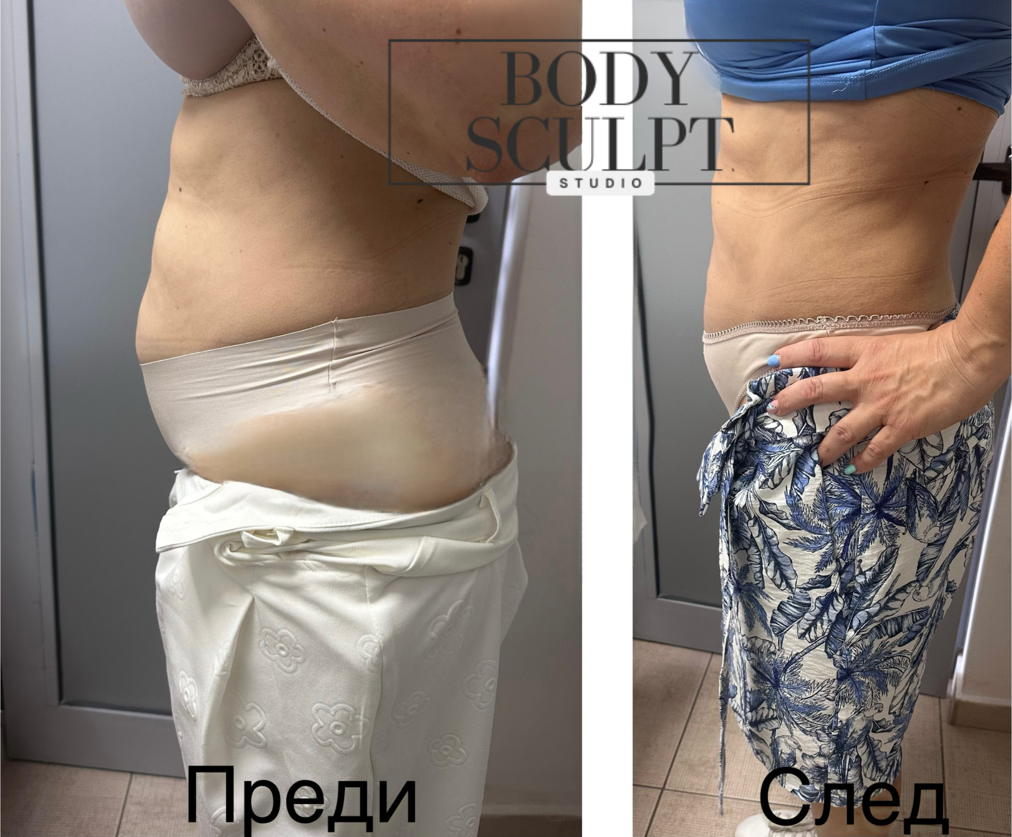 EMS резултат - стягане на корем и бедра - 6 сесии